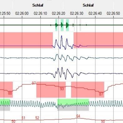 Ausschnitt aus einer kardiorespiratorischen Polygrafie mit dokumentierten Apnoen